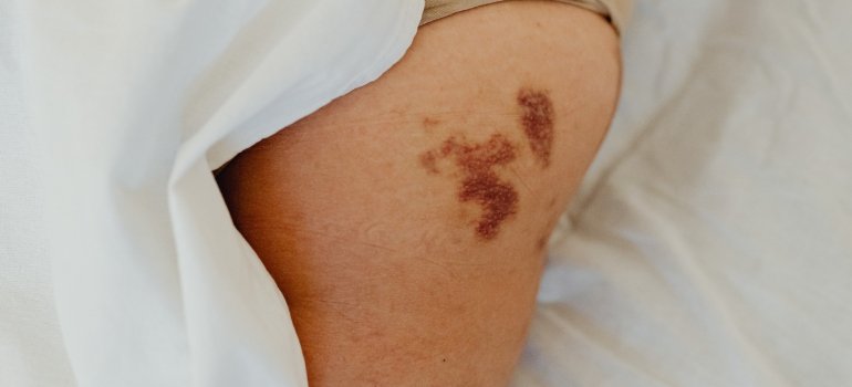 a leg bruise due to self-harm and addiction